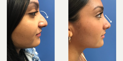 Case 4053 - Woman treated with Rhinoplasty