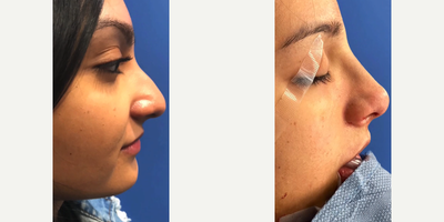 Case 4054 - Woman treated with Rhinoplasty