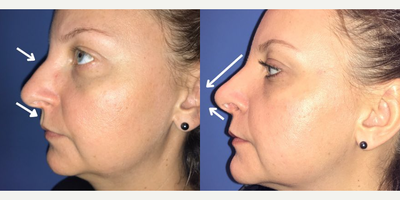 Case 4055 - Woman treated with Rhinoplasty