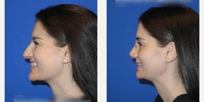 Case 4056 - Woman treated with Rhinoplasty