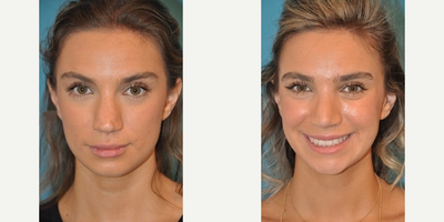 Case 4057 - Rhinoplasty