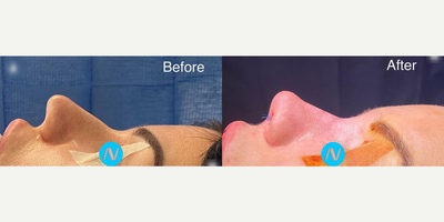 Case 4058 - Woman treated with Rhinoplasty