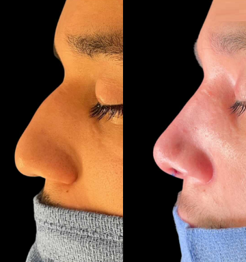 Case 4059 - Man treated with Rhinoplasty