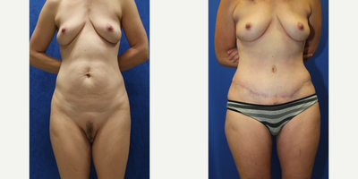 Case 406 - 43 year old woman treated with Tummy Tuck