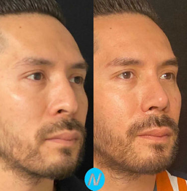 Case 4060 - Man treated with Rhinoplasty