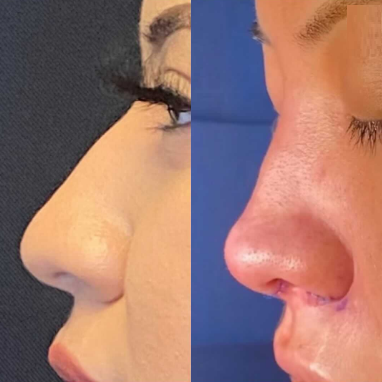 Case 4062 - Woman treated with Rhinoplasty