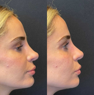 Case 4063 - Woman treated with Rhinoplasty