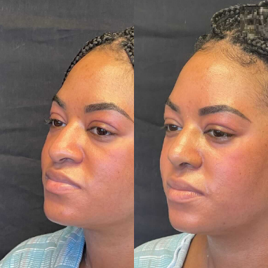 Case 4064 - Woman treated with Rhinoplasty