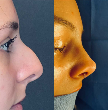 Case 4065 - Woman treated with Rhinoplasty