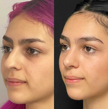 Case 4066 - Woman treated with Rhinoplasty