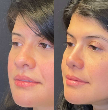 Case 4067 - Woman treated with Rhinoplasty