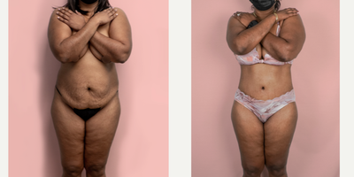 Case 407 - 45-54 year old woman treated with Tummy Tuck