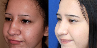 Case 4071 - Woman treated with Rhinoplasty