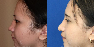 Case 4072 - Woman treated with Rhinoplasty