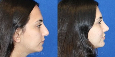 Case 4073 - Woman treated with Rhinoplasty