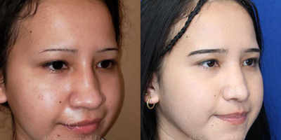 Case 4074 - Woman treated with Rhinoplasty