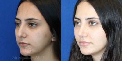 Case 4075 - Woman treated with Rhinoplasty