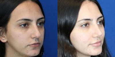 Case 4076 - Woman treated with Rhinoplasty