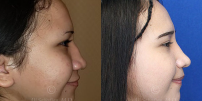 Case 4077 - Woman treated with Rhinoplasty