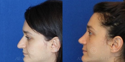 Case 4078 - Woman treated with Rhinoplasty