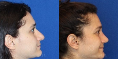 Case 4079 - Woman treated with Rhinoplasty