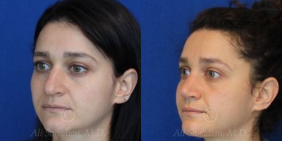 Case 4080 - Woman treated with Rhinoplasty