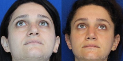 Case 4081 - Woman treated with Rhinoplasty