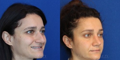 Case 4082 - Woman treated with Rhinoplasty