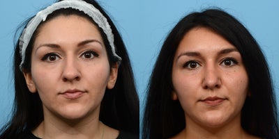 Case 4083 - 25-34 year old woman treated with Rhinoplasty