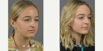 Case 4084 - Woman treated with Rhinoplasty