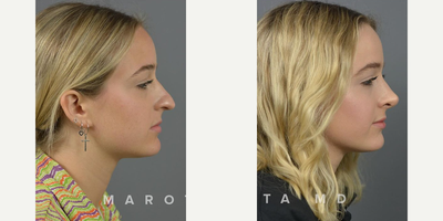 Case 4085 - Woman treated with Rhinoplasty