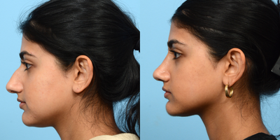 Case 4088 - 25-34 year old woman treated with Rhinoplasty