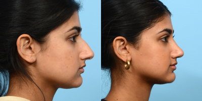 Case 4089 - 25-34 year old woman treated with Rhinoplasty