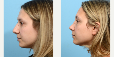 Case 4090 - 25-34 year old woman treated with Rhinoplasty