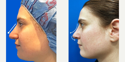Case 4094 - Woman treated with Rhinoplasty