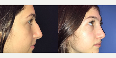 Case 4095 - Woman treated with Rhinoplasty