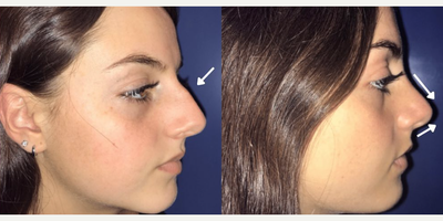 Case 4096 - Woman treated with Rhinoplasty