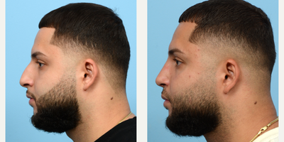 Case 4097 - 18-24 year old man treated with Rhinoplasty