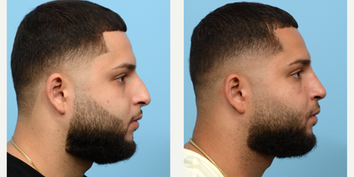 Case 4098 - 18-24 year old man treated with Rhinoplasty