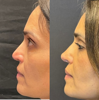 Case 4099 - Woman treated with Rhinoplasty