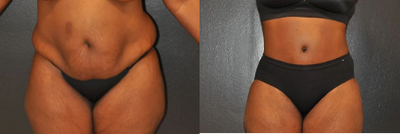 Case 41 - Woman treated with Tummy Tuck