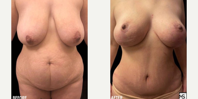 Case 410 - 40 year old woman treated with Tummy Tuck