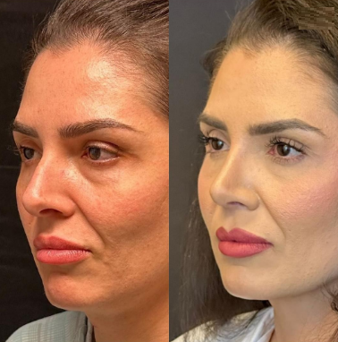 Case 4100 - Woman treated with Rhinoplasty