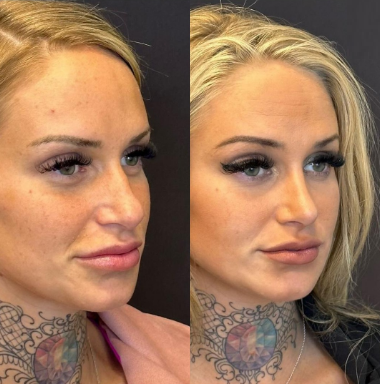 Case 4101 - Woman treated with Rhinoplasty