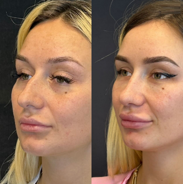 Case 4102 - Woman treated with Rhinoplasty