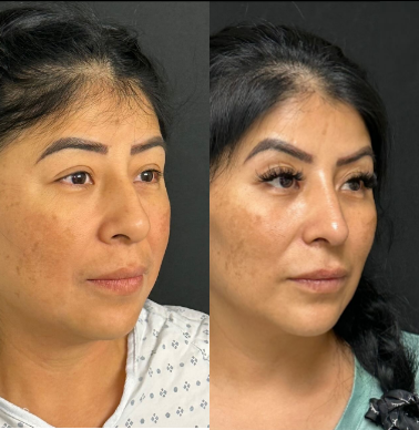 Case 4103 - Woman treated with Rhinoplasty