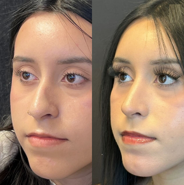 Case 4104 - Woman treated with Rhinoplasty