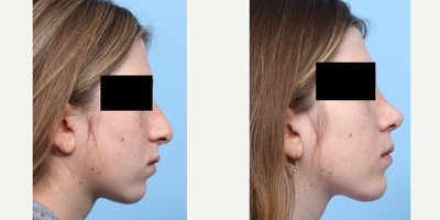 Case 4106 - 17 or under year old woman treated with Rhinoplasty, Chin Implant