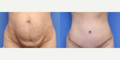 Case 411 - Woman treated with Tummy Tuck, Liposuction