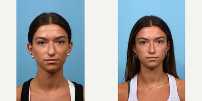 Case 4110 - 18-24 year old woman treated with Rhinoplasty